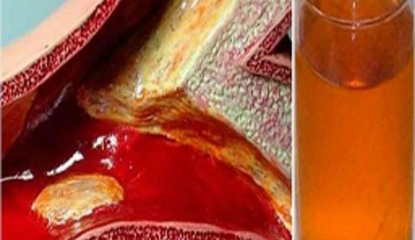 شراب يساعد على فتح الشرايين المسدودة .. النتيجة ستذهلكم!