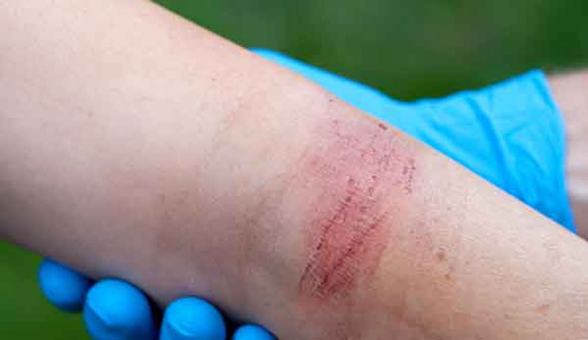 علاج الحروق في المنزل وأنواعها