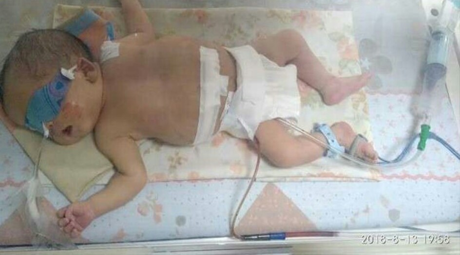 مولودة ابتلعت أختها.. جراحة نادرة في مصر (صور)