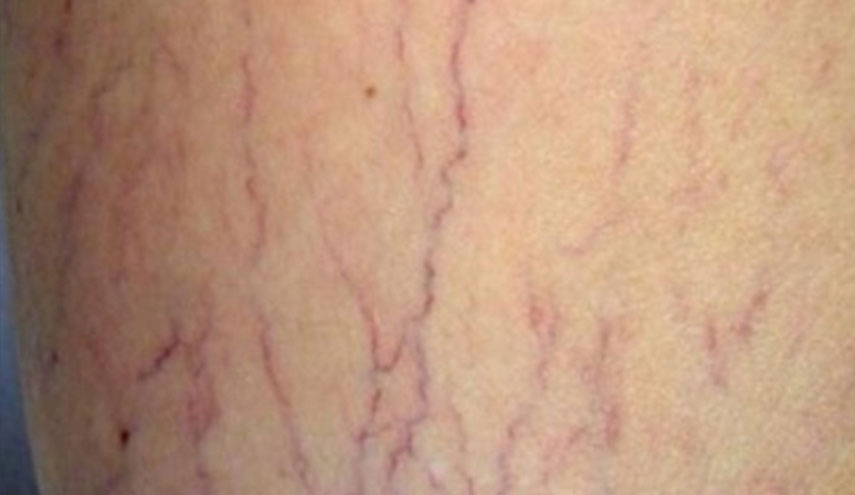 4 نصائح تضمن لك الوقاية من دوالي الساقين