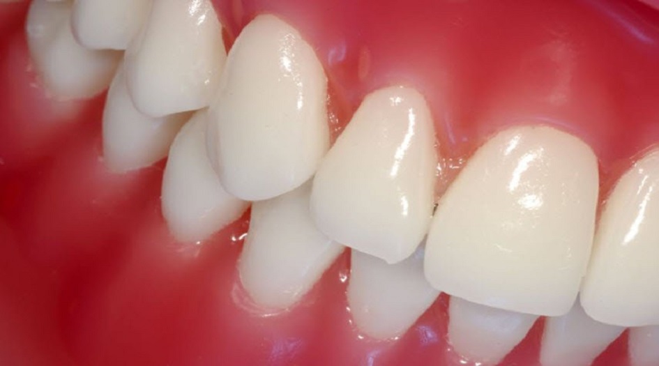  نزيف اللثة .. مؤشر هام لنقص هذه المواد بالجسم؟!