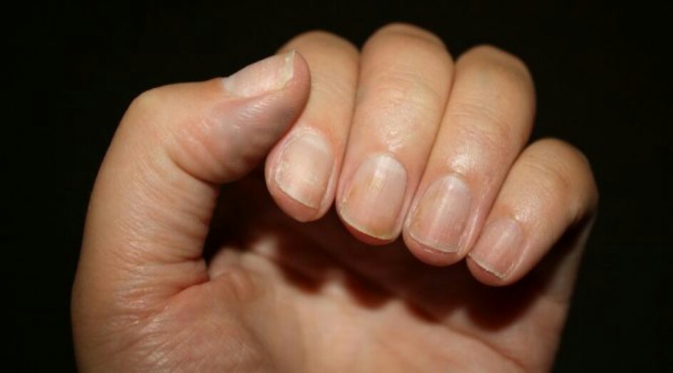 الأظافر مرآة لعرض المشاكل الداخلية…..لا تهمل هذه الأعراض