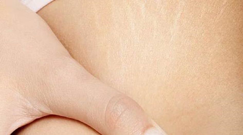 إليك هذه الخلطة السحرية للتخلص من الخطوط البيضاء في جسدك