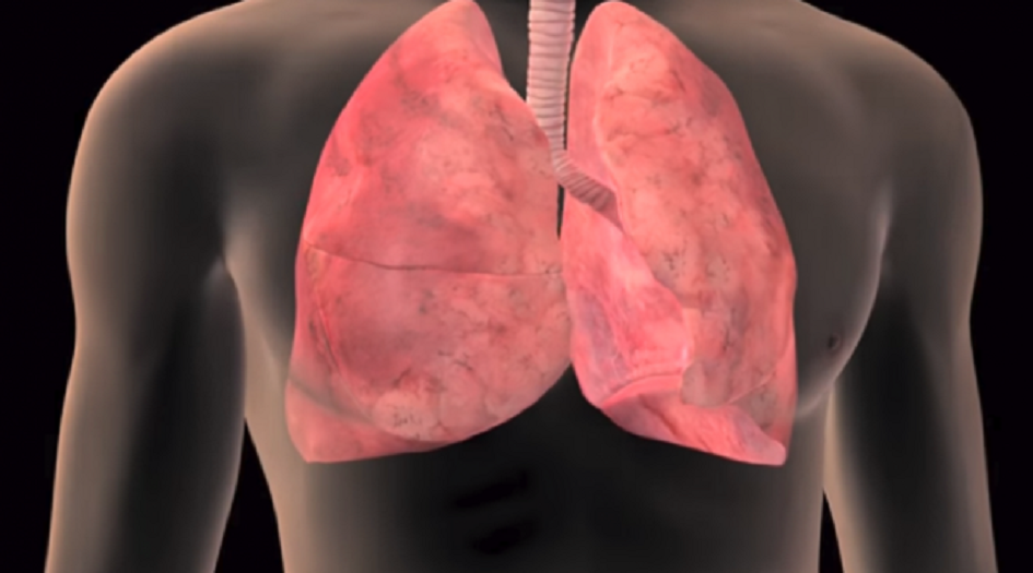 لماذا يصاب غير المدخنين بسرطان الرئة؟