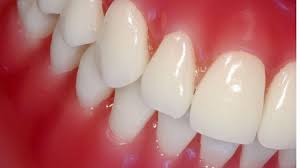 هل تعرف ان التهاب اللثة مؤشر على مرض خطير؟! 