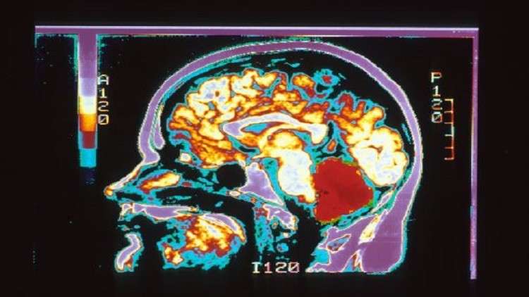 ما هي أوجه الاختلاف بين دماغ الرجل والمرأة!
