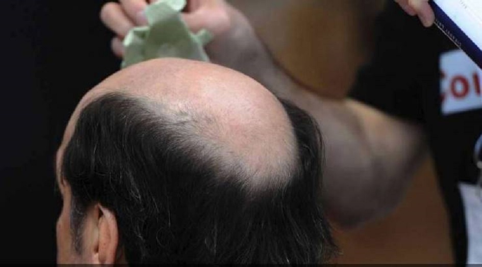  علماء يكتشفون علاجا لمشكلة الصلع التي تؤرق الملايين