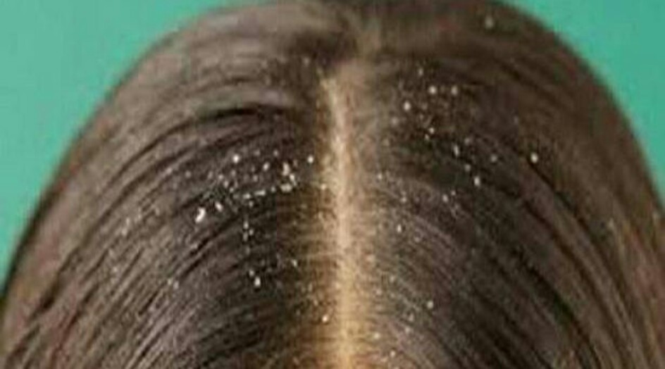 تعرفوا الى أسباب القشرة وكيف تتخلصون منها