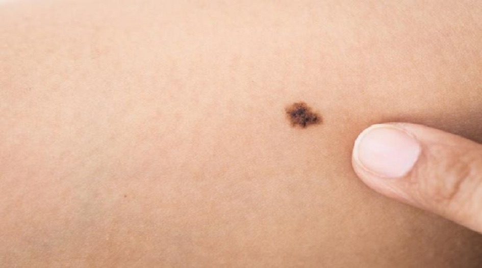  الشامة… علامة جمال أو مؤشر خطير؟