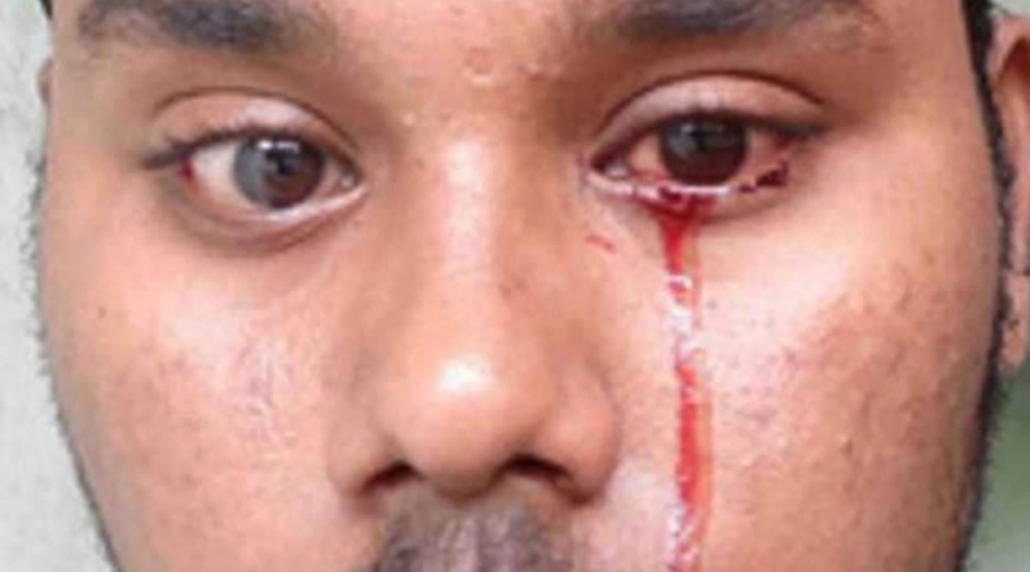 شاب يبكي دما والأطباء عاجزون!