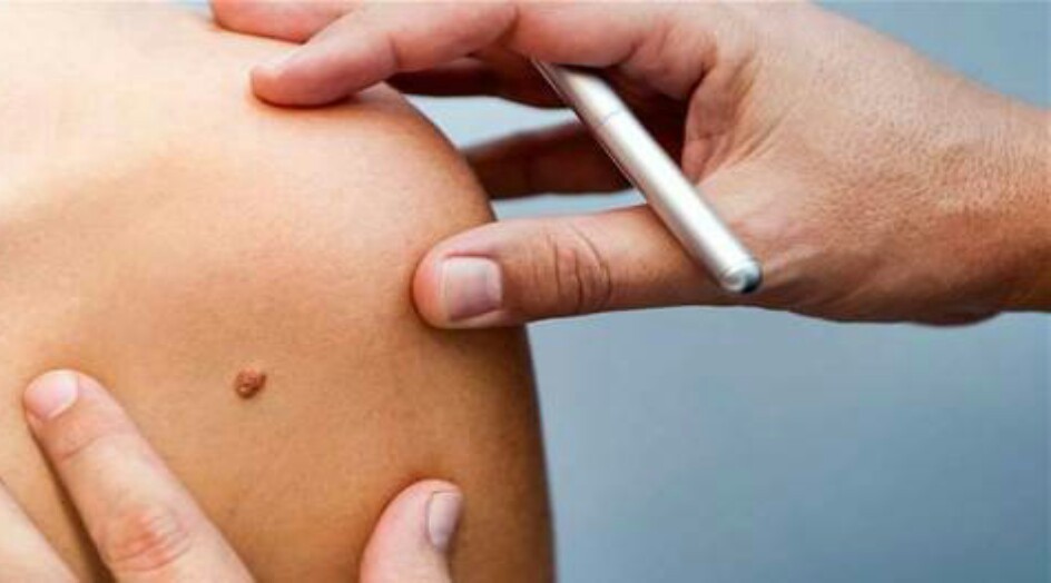 الشامة السرطانيّة.. هكذا يُمكن تمييزها