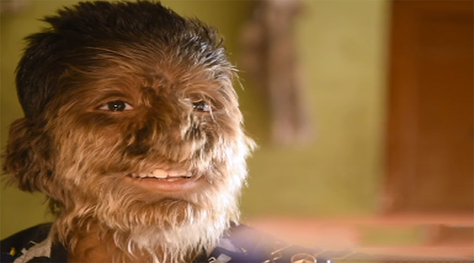 بالصور.. ظهور "الطفل الذئب" في الهند