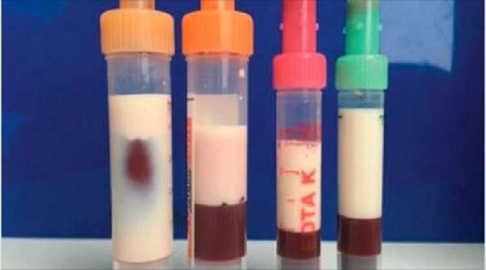 حالة نادرة رجل يتحول دمه إلى حليب  !!