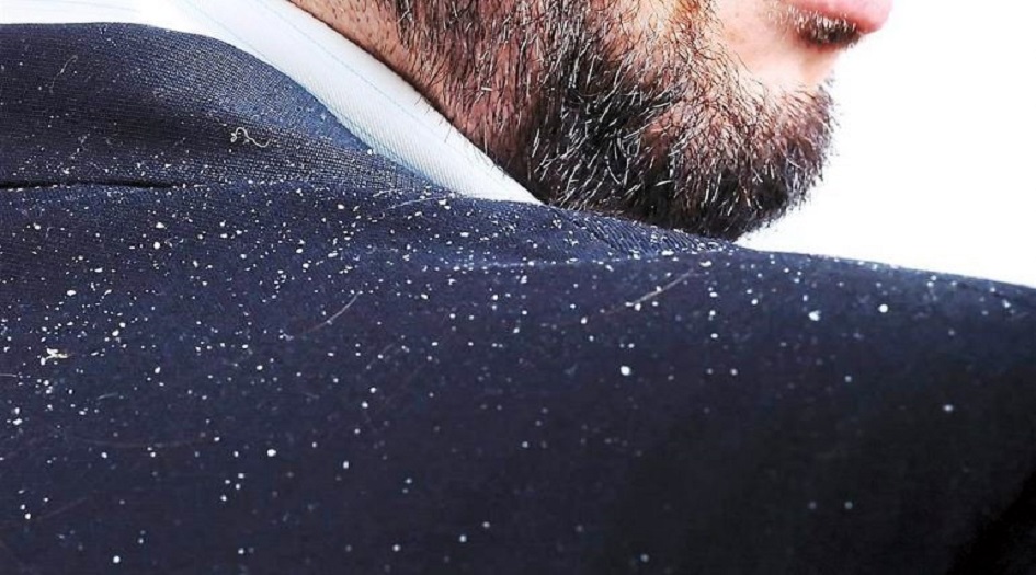 قشرة الرأس قد ترتبط بمرض خطير!