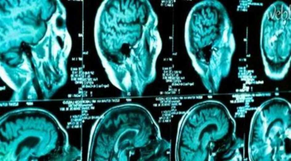 لا تتجاهل هذه الأعراض.. قد تؤشر الى الاصابة بنوع قاتل من السرطان!