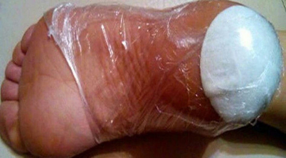 الوصفة المعجزة التي تشفي الفاريس (الدوالي)، مسامير القدم وتشقق الكعب في أيام!