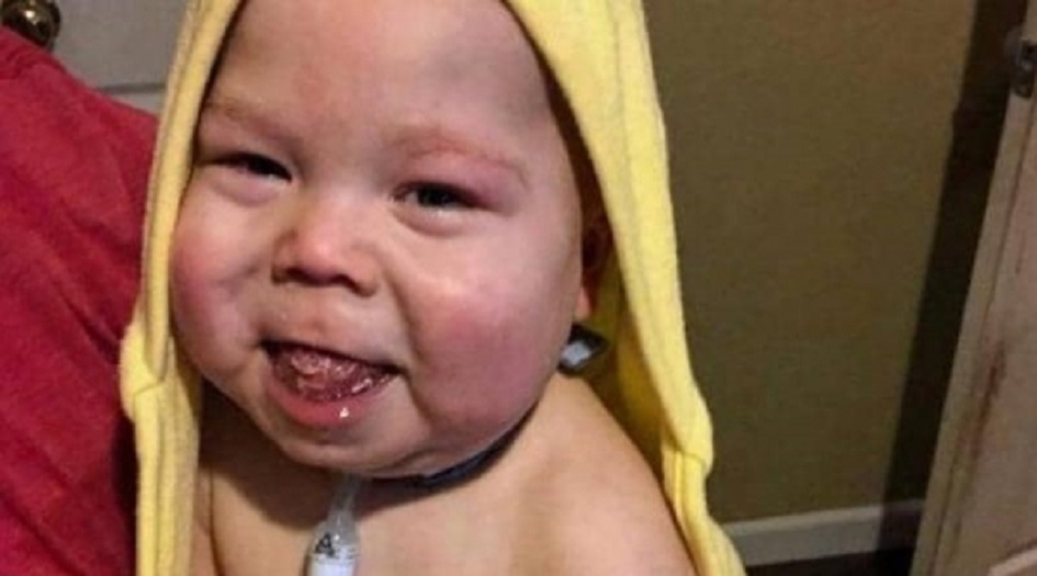 جراحة نادرة.. قطعو لسان طفل رضيع ليتكلم!