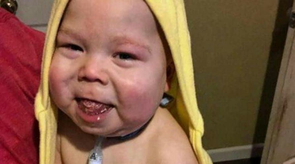 رضيع يتم قطع لسانه بهدف انقاذه