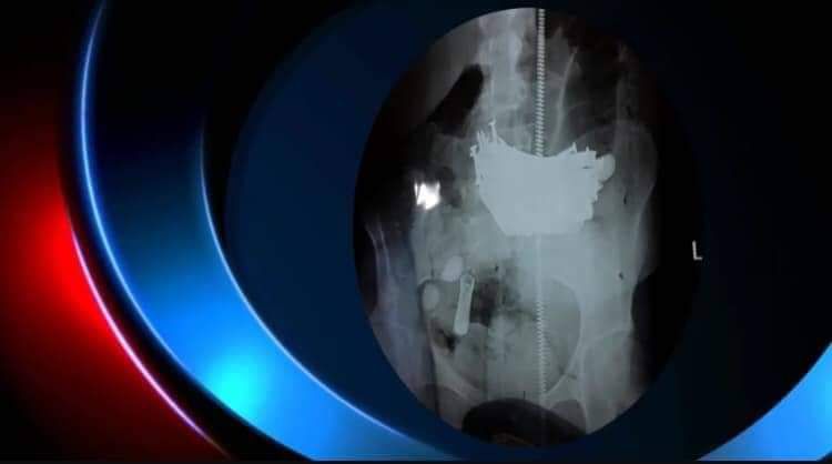 بالصورة ..استخراج كيلو غرام مسامير من معدة مريضة في السماوة