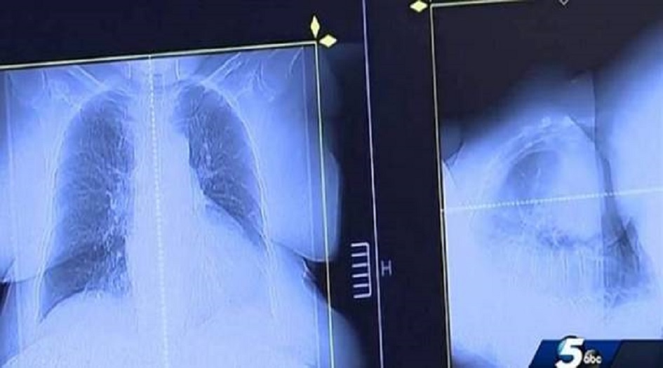 توقع الأطباء وفاته في غضون 3 أشهر.. فعالج نفسه من السرطان بدواء للكلاب!!