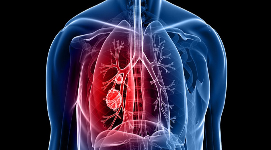 هذه المواد تبعث الحياة في رئة المدخنين