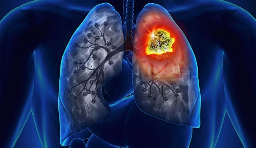 خبر سار: علماء صينيون يتوصلون لـ"علاج محتمل" لسرطان الرئة
