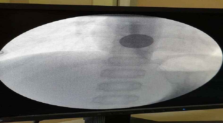 لأول مرة بالمثنى.. انجاز طبي فريد باستخدام الناظور +(الصور)