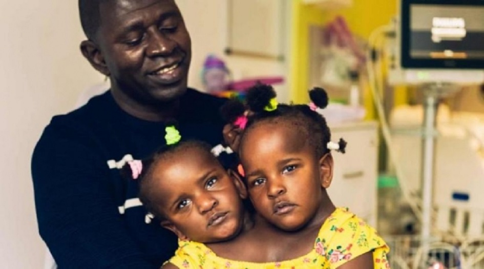 أب لتوأمتين ملتصقتين أمام قرار احلاهما مر