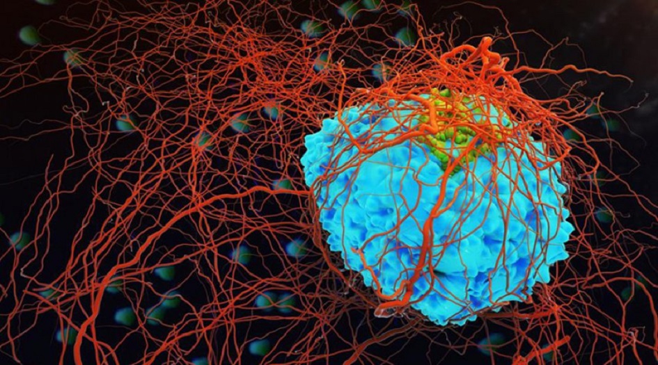 تحذير طبي من أخطر انواع السرطان