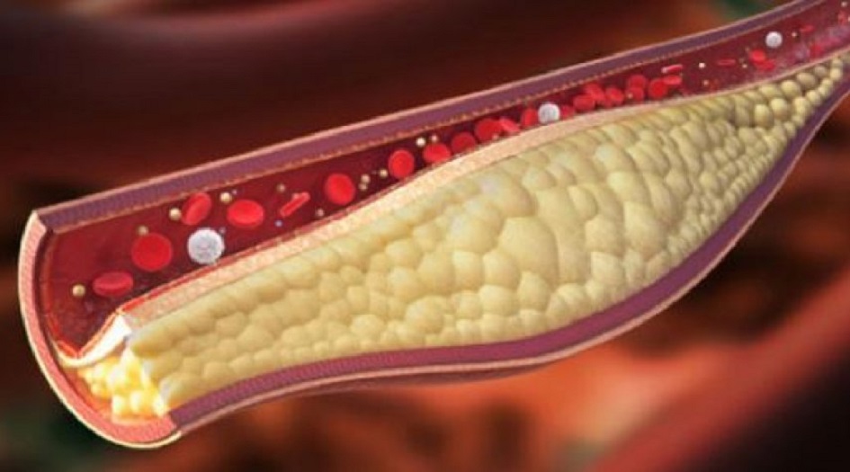 بشرى لمن يعانون من الكولسترول المرتفع
