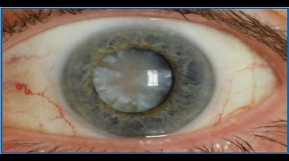 تعرف على اسباب الاصابة بـ "الساد"