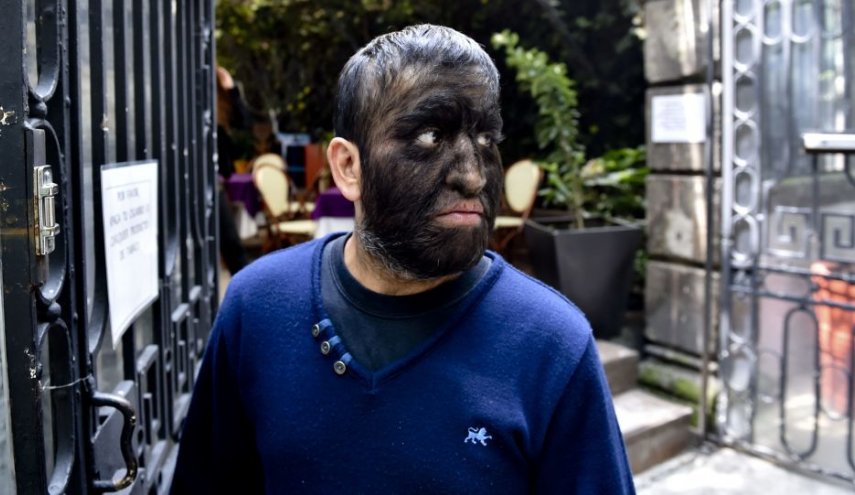 صادم.. أطفال يتحولون إلى ذئاب بسبب مرض غريب