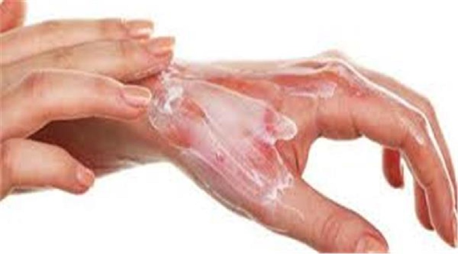 معجون الأسنان و...أخطاء نرتكبها بالإسعافات الأولية لمعالجة الحروق!