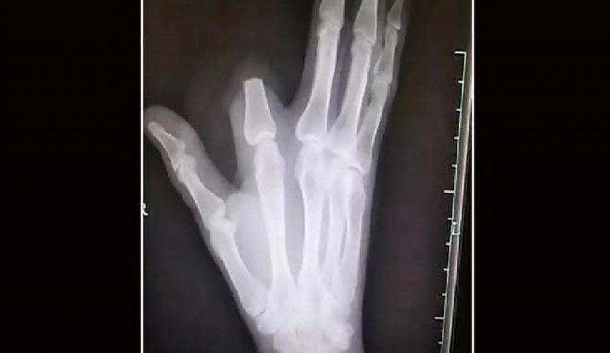 قطع إصبعه بسبب لدغة أفعى..ثم اكتشف "المفاجأة الصاعقة"