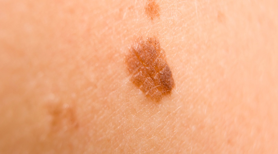 تعرف على الفرق بين الشامة الخبيثة والحميدة