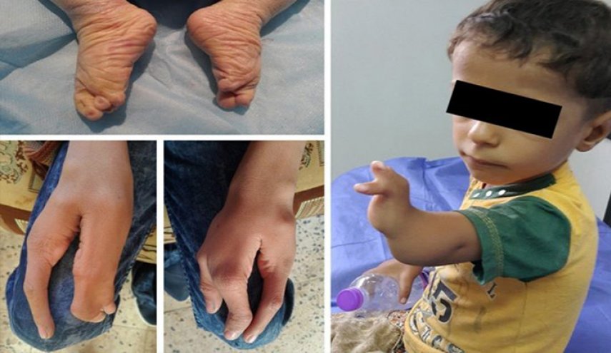 صحيفة أمريكية تكشف عن تورط القواعد الأمريكية بتشوهات الأطفال في العراق!