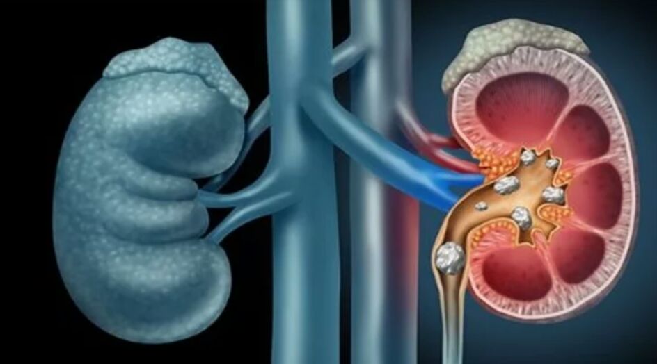 هكذا يمكن تنظيف حصوات الكلى والتخلّص منها