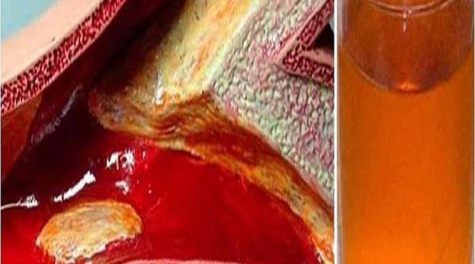 شراب طبيعي يساعد على فتح الشرايين المسدودة