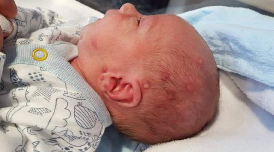 أصغر مصاب بالكورونا في ايران.. إصابة رضيع عمره شهر