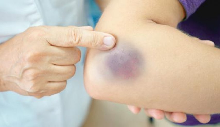 ظهور كدمات مفاجئة على جلدك تنذرك بمشاكل صحية خطيرة‎