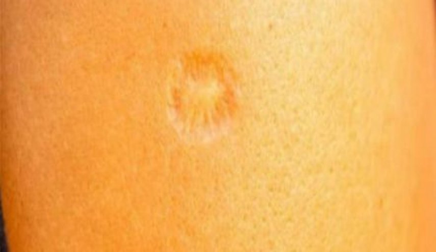 علماء: إذا كانت بذراعك هذه العلامة فأنت في مأمن من 