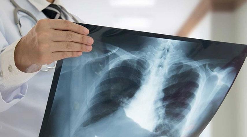 7 مضاعفات محتملة لكورونا قد تكون دائمة