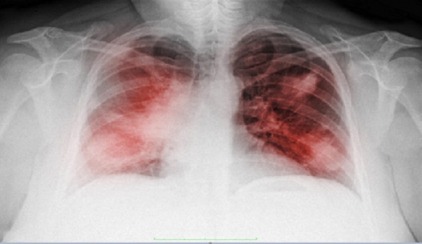 علامات السرطان التي تنسب لأعراض "كوفيد-19"