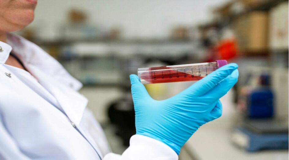 باحثون يحددون 5 مؤشرات حيوية قد تكشف خطر الوفاة نتيجة عدوى "كوفيد-19"!