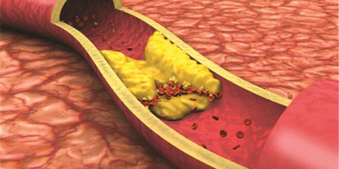 بخطوات بسيطة… واجهوا ارتفاع نسبة الكوليسترول السيء في الدم!