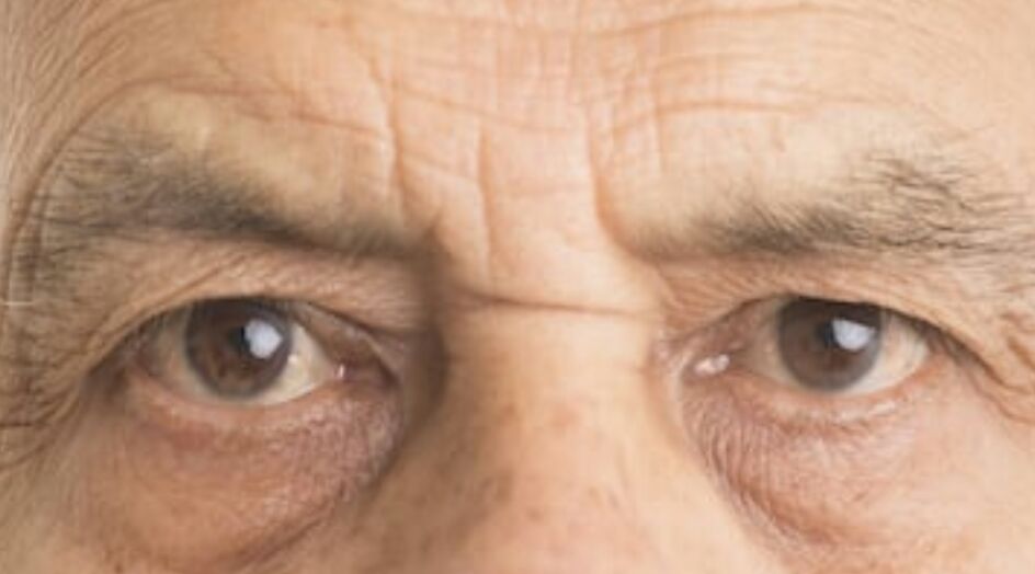 ظهور علامة غريبة في العينين ينوه بنقص فيتامين أساسي!