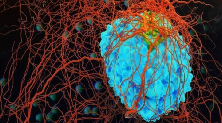 طريقة بسيطة لتخفيض خطر الإصابة بالجلطة الدماغية والسرطان