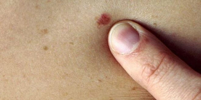 احذروا.. الشامة الحمراء تشير للإصابة بمرض خطير
