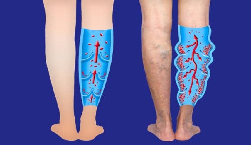 تعرف على الأسباب والعلاج للجلطة في الرجل