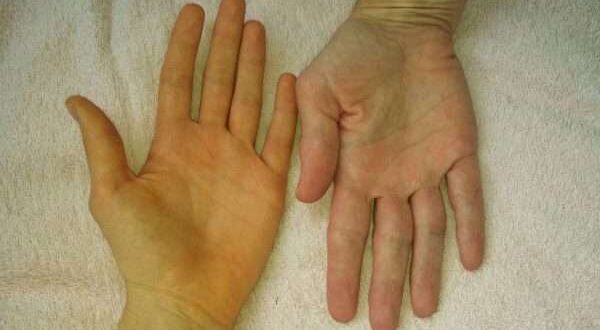 لماذا قد يتغير لون اليدين؟. ما الأسباب المحتملة لحدوث ذلك؟